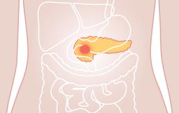 «На первых стадиях симптомов обычно нет»: что нужно знать о раке поджелудочной железы